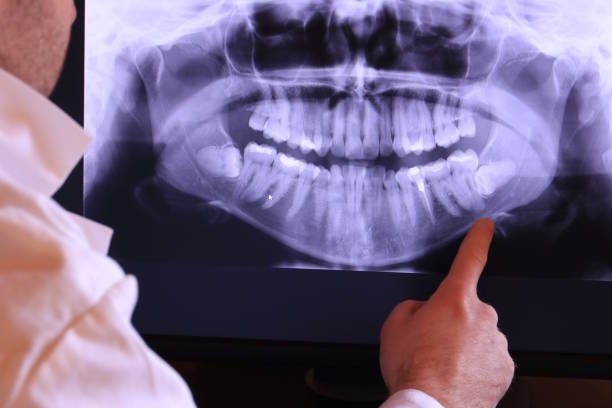 Best Emergency Treatment for Dental Infections or Abscesses in New Waverly, TX