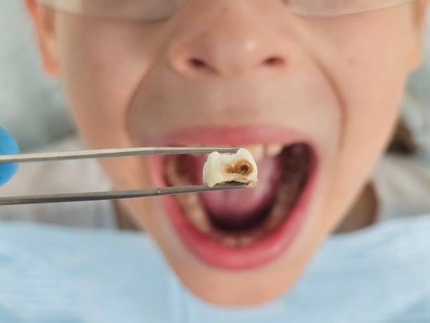Best Emergency Dental Care for Broken or Chipped Teeth in New Waverly, TX